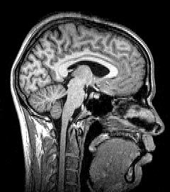 Sagittal_brain_MRI
